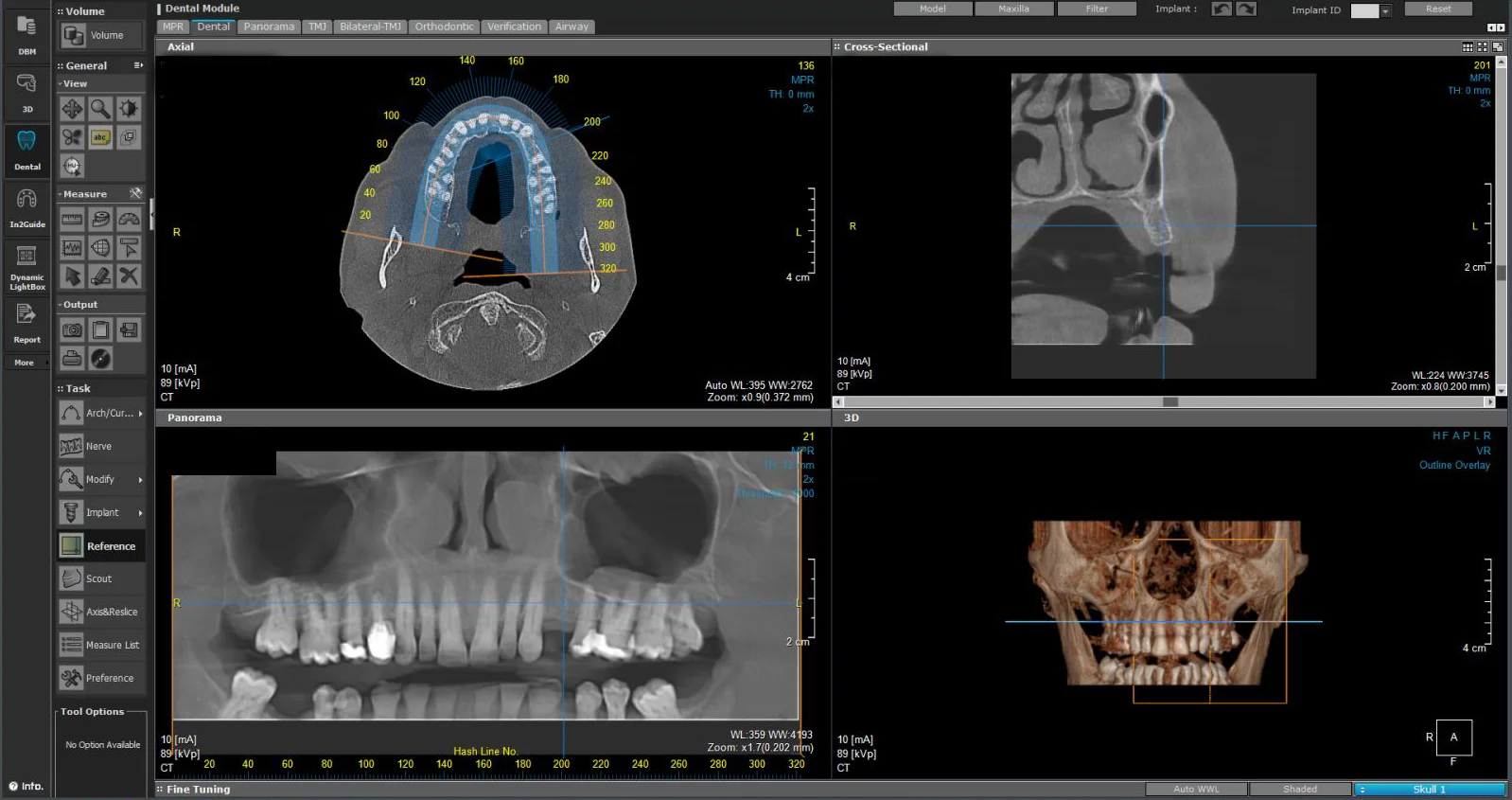 3D Snimanje zuba (CBCT)